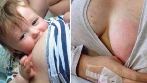 dolor de la lactancia materna