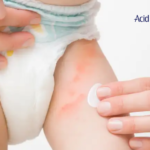 ¿Qué es la dermatitis del pañal?