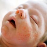 Dermatitis atópica en bebés, ¿Cómo tratarla?