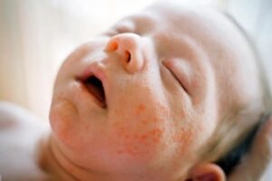 dermatitis atópica
