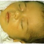 ¿Que es la ictericia neonatal?