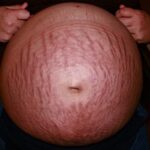 Estrías: todo lo que debes saber