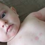 Alergias en niños: Causas, tipos y tratamiento