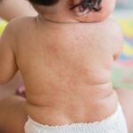 Qué es la meningitis en bebés y cómo tratarla